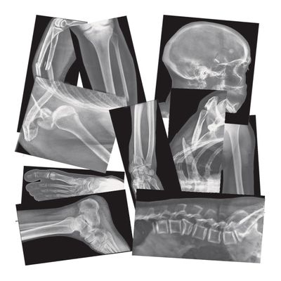 Roylco Broken Bones X-Ray Set, Projector Display Compatible, 15 X-Rays