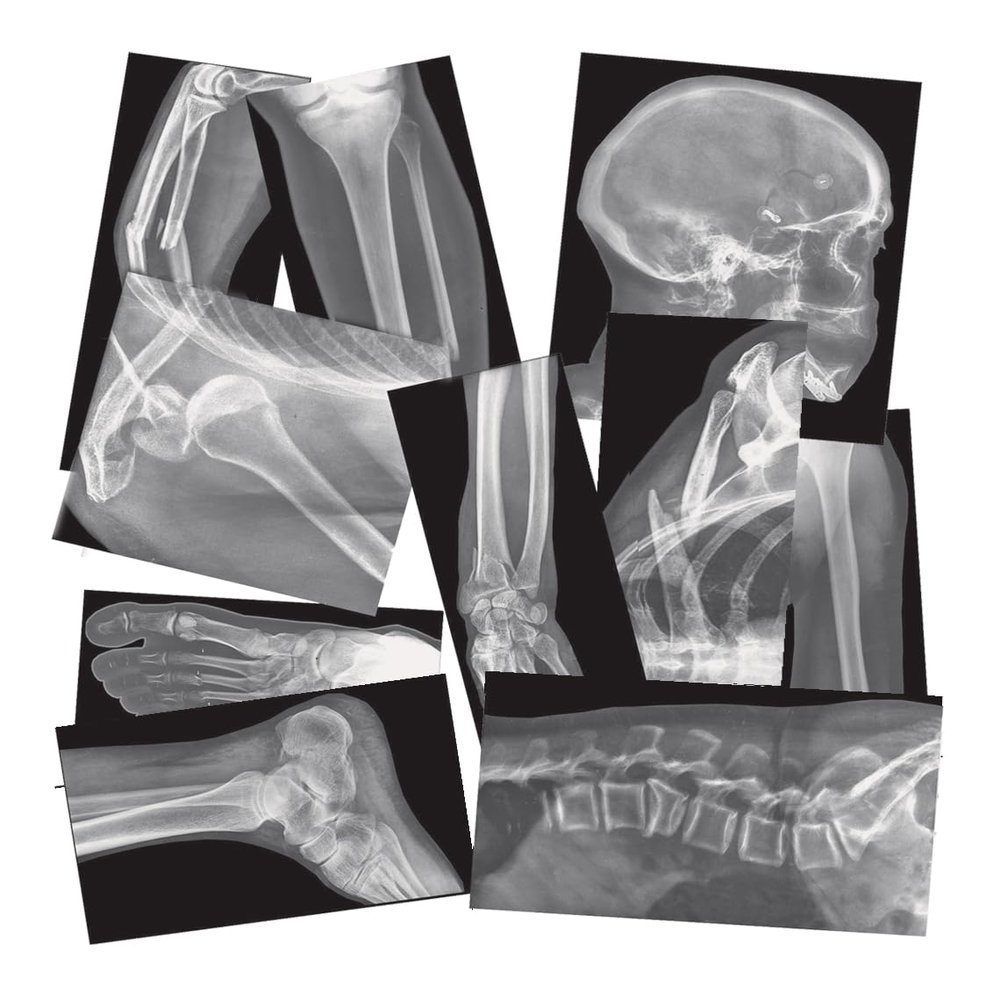 Roylco Broken Bones X-Ray Set, Projector Display Compatible, 15 X-Rays