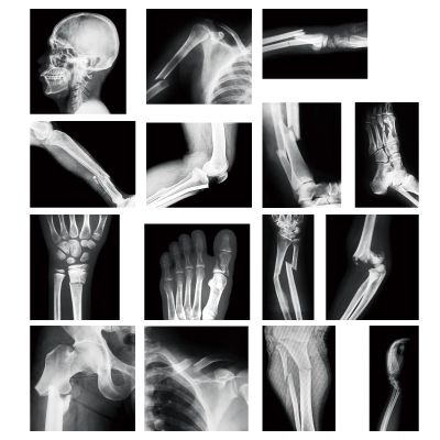 Sayglossy 15 Pcs Broken Bones x Ray Set Human x Rays Black and White Skeleton Pretend Xrays for Kids