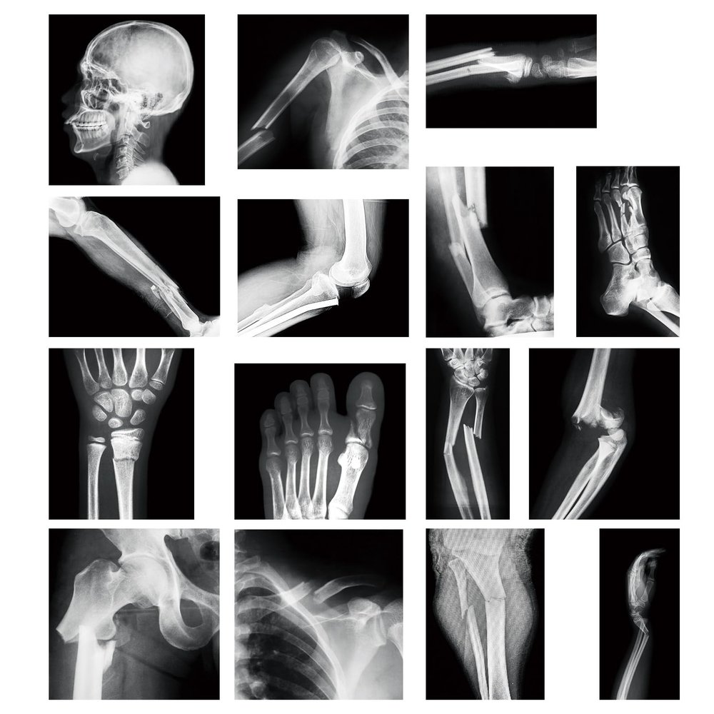 Sayglossy 15 Pcs Broken Bones x Ray Set Human x Rays Black and White Skeleton Pretend Xrays for Kids