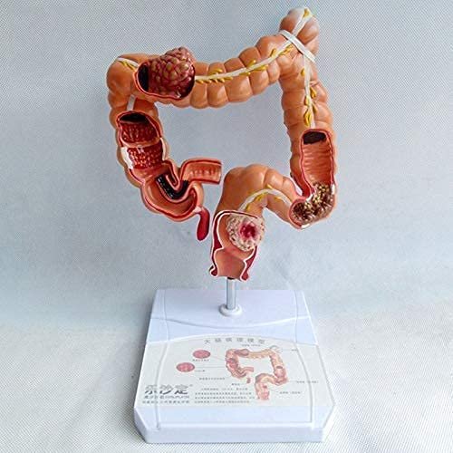 3UOOWWFA Anatomy Model,Colon Model,Human Colon Large Intestine Lesion Pathological Disease Model,Colon Human Anatomy Replica W/Common Pathology for Doctor's Office Teaching Tool