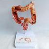 3UOOWWFA Anatomy Model,Colon Model,Human Colon Large Intestine Lesion Pathological Disease Model,Colon Human Anatomy Replica W/Common Pathology for Doctor's Office Teaching Tool view 1