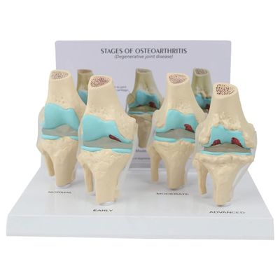 4-Stage Knee Joint Disease Model, PVC Life Size Lesion Knee Joint Model, Osteoarthritis Anatomical Model, with Back Card and Display Base, for Study Display Teaching
