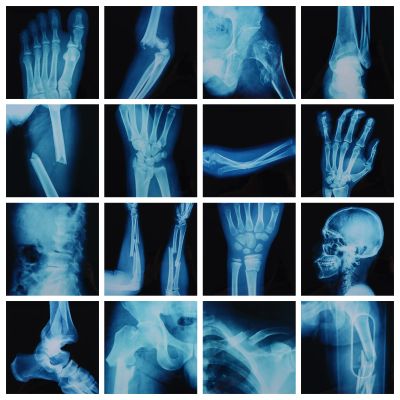 16Pcs Realistic Broken Bones X-Ray (9.8"x9.8") Skeleton X-Rays Human Skeleton Broken Bones PVC Plastic X-Ray Pretend Play Doctor Kit Learning Toy for Role-Playing Homeschooling School Supplies