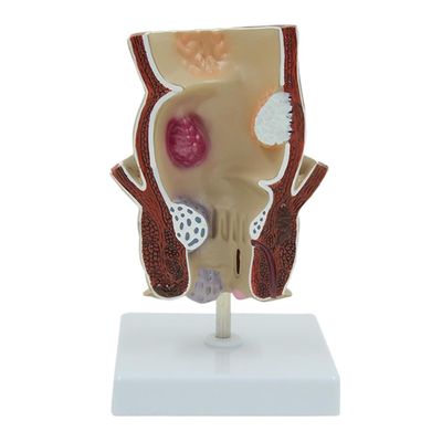 Human Rectal Pathological Anatomy Model, Internal and External Rectal Hemorrhoids Hemorrhoids lesions Model, Colon Anus Sphincter Specimen for Medical Research Teaching Display.