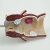 Human Rectal Pathological Anatomy Model, Internal and External Rectal Hemorrhoids Hemorrhoids lesions Model, Colon Anus Sphincter Specimen for Medical Research Teaching Display. view 3