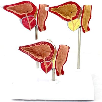 1:1 Life Size Human Prostate Anatomical Model | Normal & Pathological Prostate Model for Medical Education & Demonstration